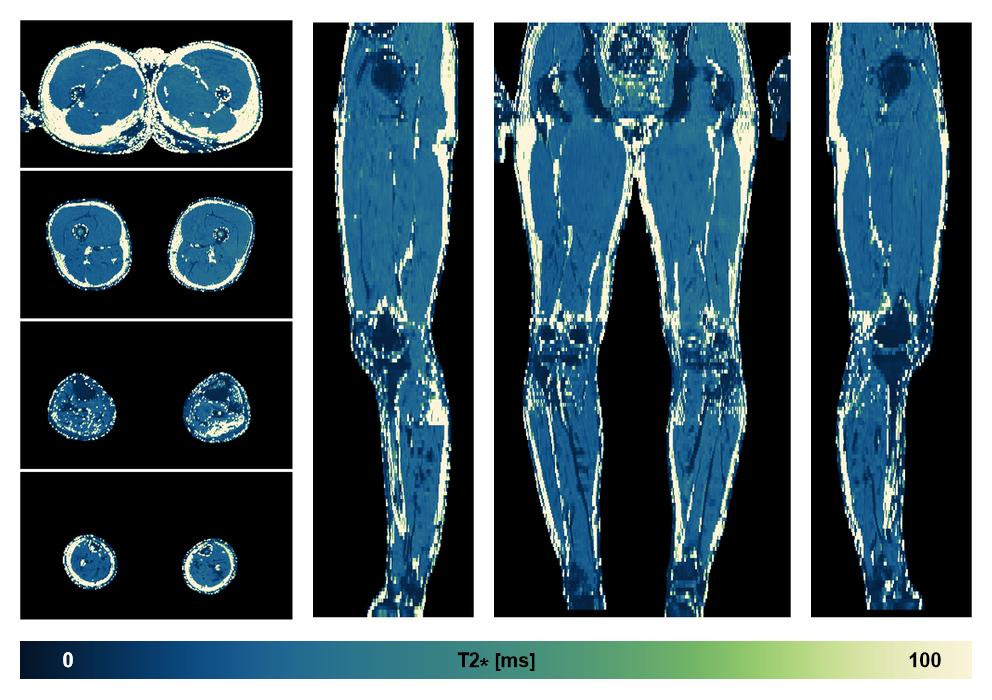 The T2 star relaxation time of the lower extremity obtained from the dixon reconstruction for muscle water fat quantification.